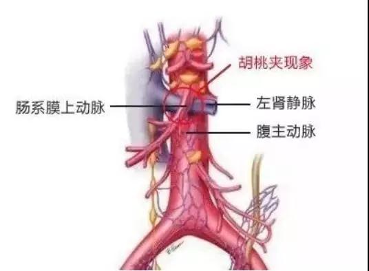 胡桃夹现象是肾炎吗?两者如何区别?